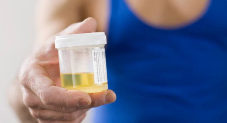 Descubre cómo es el color de la orina en las personas con insuficiencia renal