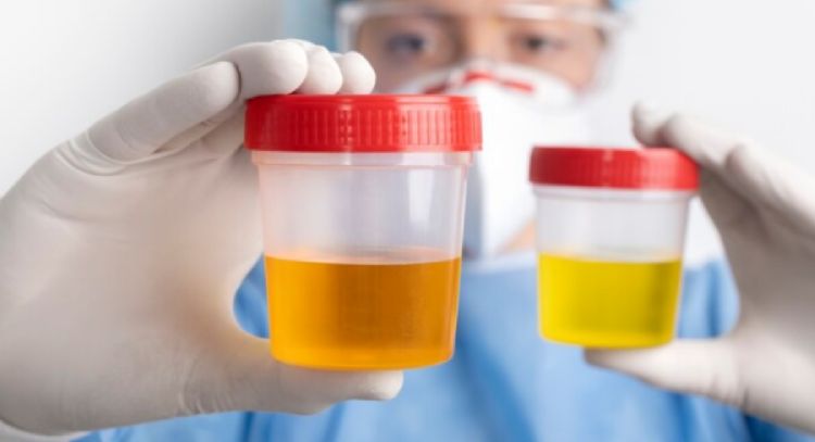 Descubre cuál es el color de la orina en personas que padecen diabetes