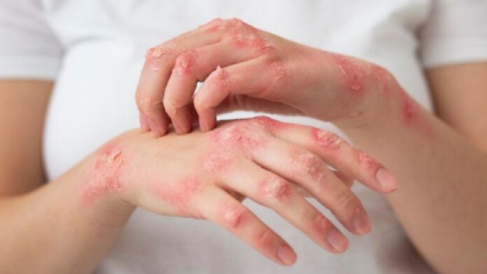 ¿Sufres psoriasis en la piel? 5 formas de tratarla