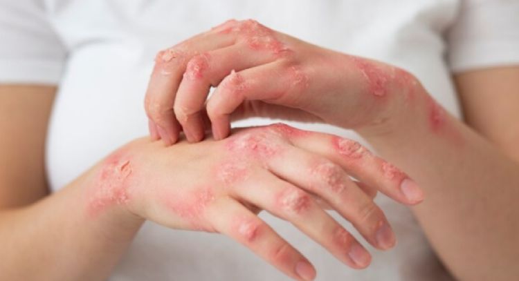 ¿Sufres psoriasis en la piel? 5 formas de tratarla
